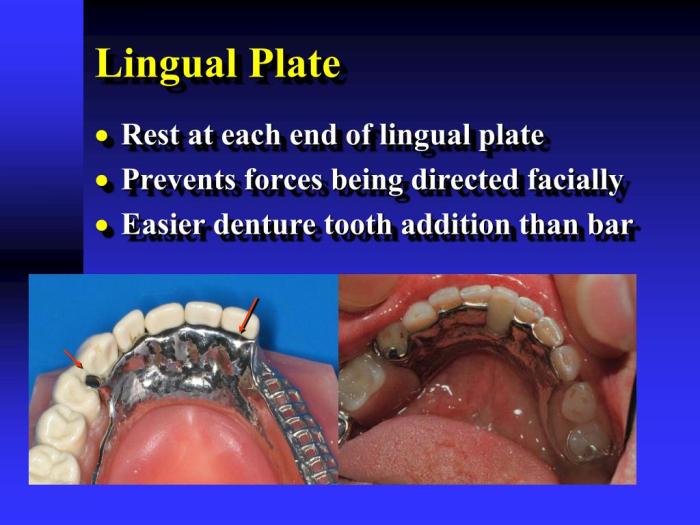 Lingual bar vs lingual plate