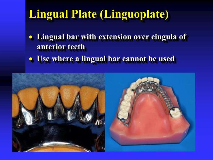 Lingual plate major bar connectors connector mandibular used over ppt powerpoint presentation indications slideserve