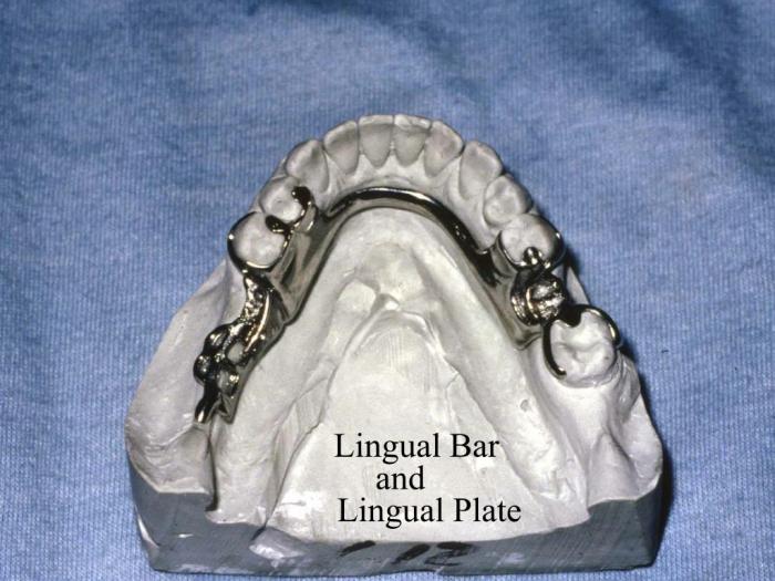 Lingual bar vs lingual plate